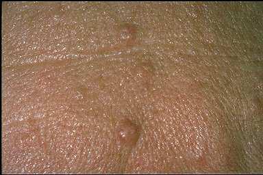 Sebaceous hyperplasias are benign growths. They never become cancerous. At times I cannot be 100% sure by looking at the growth if it is truly benign or not.