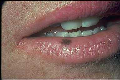 BENIGN LABIAL LENTIGO A benign labial lentigo is a harmless growth. The term labial refers to mucosal surfaces such as the lip or genital skin. The term lentigo refers to a small dark area.