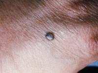 BLUE NEVUS (BLUE MOLE) A blue nevus is a type of a benign growth that is gray-blue to bluish-black in color. It can be flat or slightly raised and is generally smooth.
