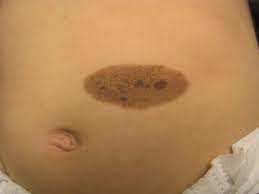 Congenital nevus (Birthmark) A congenital nevus (plural-nevi) is a type of birthmark. Congenital means something that is present in the skin at birth. Nevus is the medical word for a mole.