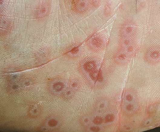ERYTHEMA MULTIFORME Erythema multiforme is the medical name for a skin condition which abruptly appears on the skin.