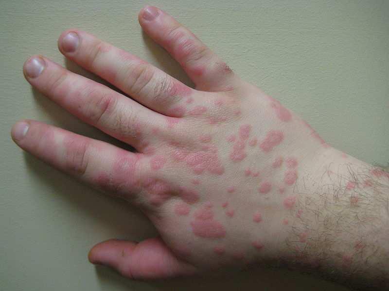 The initial lesions are round red bumps which progress to a target-like appearance. There may be an associated itch or burning sensation.