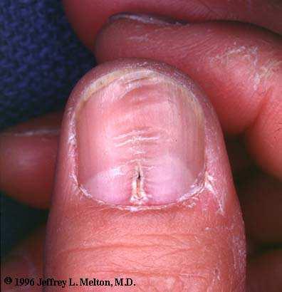 HABIT TIC Habit tic is a term that refers to a condition which affects the nails.