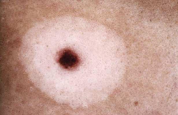 Halo Nevus The term halo nevus is used to describe a mole (nevus) surrounded by a ring of lighter skin.