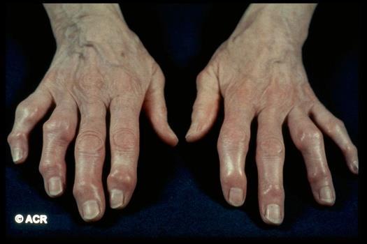 Know It When You See It Osteoarthritis: Typical hand Hard boney enlargements Heberden s nodes at the DIP