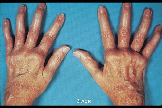 Rheumatoid arthritis Know It When You See It Soft synovial swelling Synovitis and volar subluxation