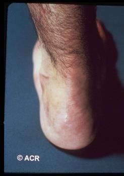 Reiter s Syndrome (Reactive Arthritis) Seronegative asymmetric arthritis Following: Urethritis or cervicitis Infectious