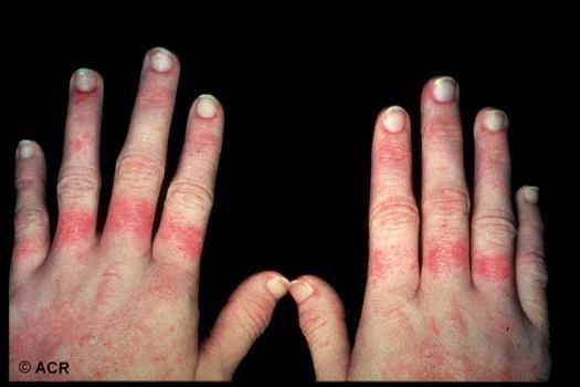 Know It When You See It Systemic lupus erythematosus Interarticular dermatitis Also has