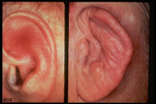 Know It When You See It Relapsing polychondritis Left: Ear changes with