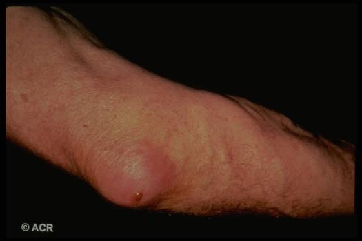 Septic olecranon bursitis Swelling of the bursa Erythema