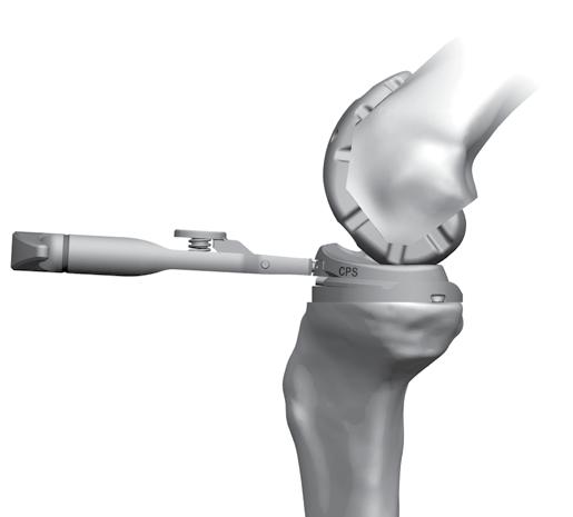 2 SECTION CPS Tibial Articular Surface Provisional (TASP) Assembly CPS TASP Removal Disengage the provisional lock down screw by rotating the 3.5mm Hex Driver in a counterclockwise direction.