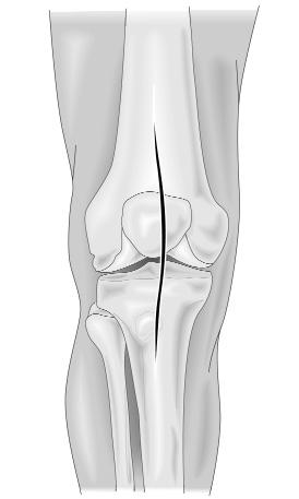 Minimally Invasive Surgical Exposure Sufficient surgical exposure is critical in total knee arthroplasty.