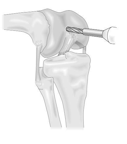 Femoral Open The Femoral Canal Using the IM Femoral Drill Guide and the 8mm (5/16 inch) IM Femoral Drill, locate and drill a pilot hole into the intramedullary femoral canal (see Figure 5).