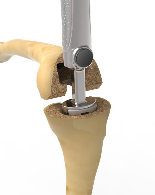 After inserting the cone trial, remove the broach rod and the stem extension trial from the tibia.