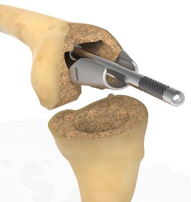 Attach the CC Trial Extractor to the LPI Slaphammer and insert the extractor into the CC Femoral Trial.