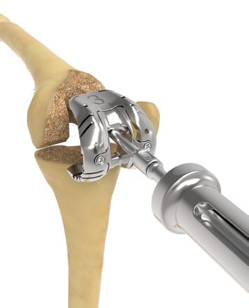 Thread the Metaphyseal Cone Broach Rod into the Stem Extension Trial in the femoral bone (Figure 10).