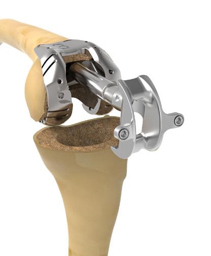 Using the impactor for initial insertion can potentially alter the geometry of the bone cavity. Insert the appropriate Metaphyseal Femoral Cone Trial in the bone.