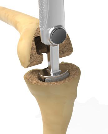 IMPLANT CONES Figure 18 Impact Tibial Cone Figure 20 Implant Cones Figure 19 Impact Femoral Cone IMPLANT CONES As a