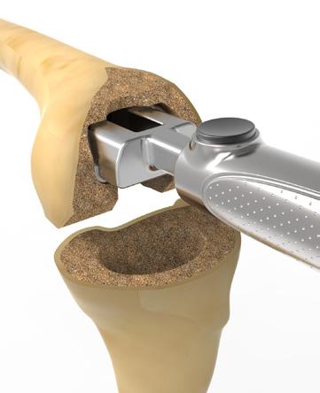 Assemble the appropriate Tibial or Femoral Cone Impactor with the Universal Handle.