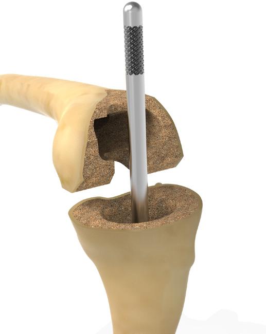 TIBIAL BONE PREPARATION Figure 1 Remove FIT Tray Trial Figure 2 Metaphyseal Cone Broach Rod Assembly TIBIAL BONE PREPARATION TIBIAL SIZING If only a Metaphyseal Femoral Cone is required,