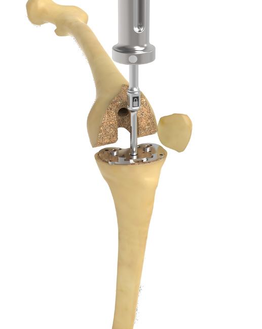 Once fit of the trial is assessed, use the Hex Driver to loosen the screws attaching the stem extension trial to the FIT Tibial Tray Trial.