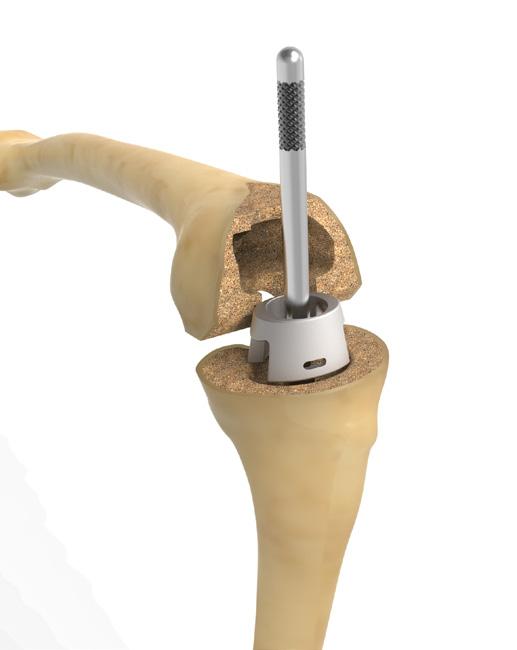 TIBIAL BONE PREPARATION Figure 3 Tibial Sizing Select a Metaphyseal Tibial Cone Trial that is approximately the correct size and depth of the defect.