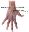 of vein Patient s age, size, general