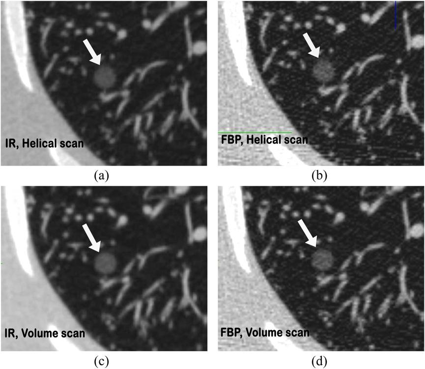Full paper: Thoracic phantom study for lung nodule volumetry BJR Figure 2.