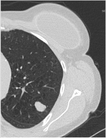 sub-solid nodules can represent primary lung cancer