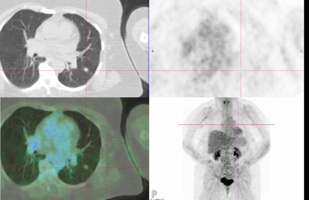 Fig. 9: Subsequent PET-CT does not demonstrate increased metabolic