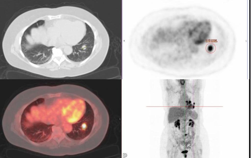 Fig. 13: PET-CT performed due to risk of malignancy shows increased metabolic activity in keeping with malignancy.