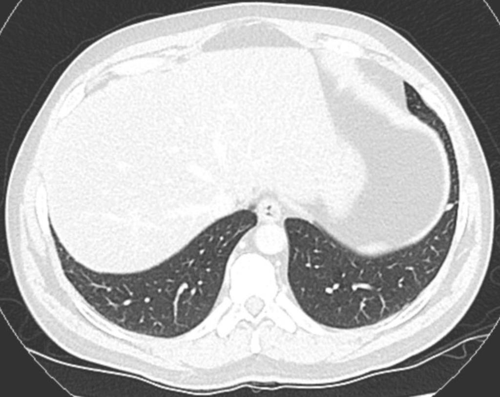 Fig. 4: Small intrapulmonary lymph node within the