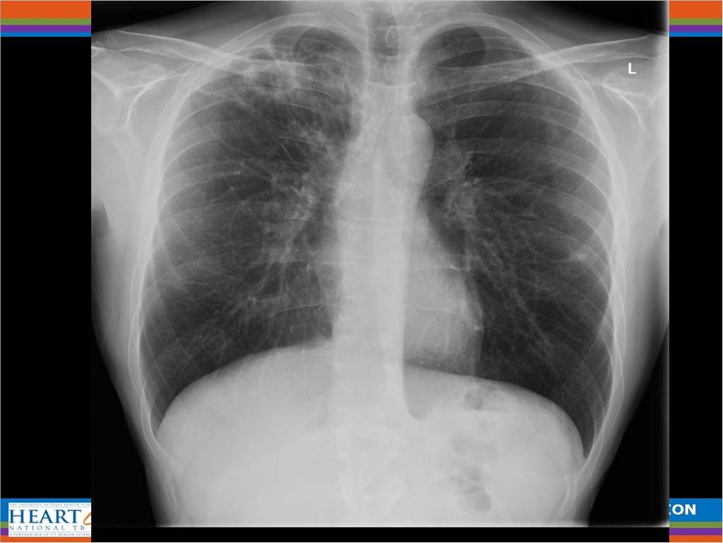 MAC: Hypersensitivity-Like Lung Disease ( Hot tub lung ) (Hanak et al Respir Med 2006, 100; 610) Prognosis generally excellent: most patients recover