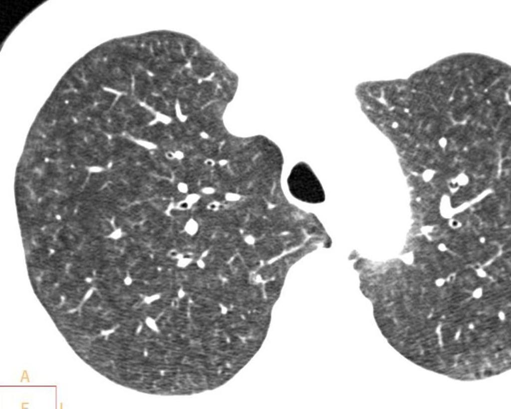 Fig. 16: Hypersensitivity micronodules. pneumonitis. Ill-defined ground-glass centrilobular Fig.