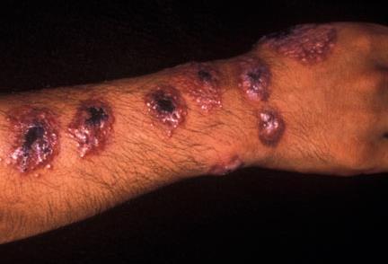 Clinical forms: Cutaneous Skin lesions where sandflies fed.