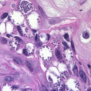 Diagnosis: Microscopy In tissue specimens, only amastigotes are seen using Giemsa or H&E.