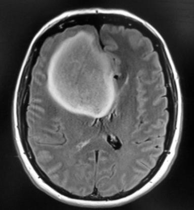 Glioma Grading Diffuse Low-grade Young patients