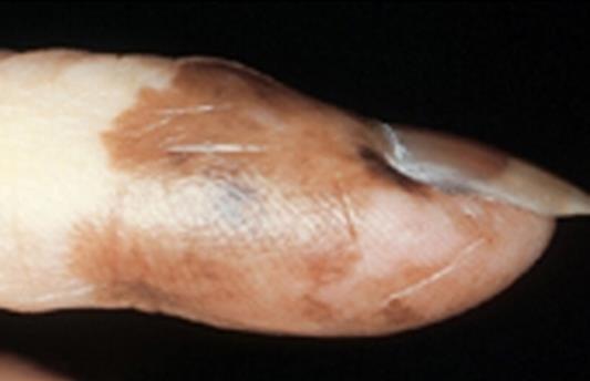 Extension of pigmentation onto the nail