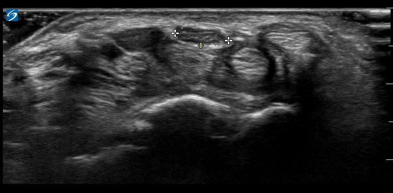 Nerve ultrasound median nerve