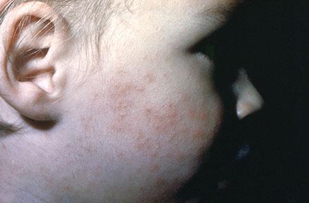 Enterovirus D68 Enteric virus Identified in 1962, occurred rarely Unusual as it causes a respiratory