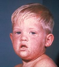 Measles Measles is not trivial recent US cases: 25%