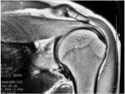 MRI ANATOMY Rotator Cuff Tear