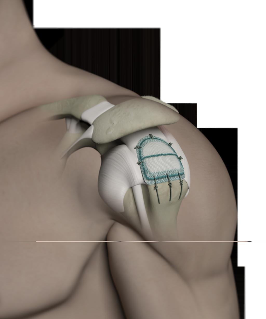 INDICATIONS The Leeds-Kuff Patch is a single use device intended to be used for reinforcement of the rotator cuff following or during repair by suture or suture anchors, where one or more of the