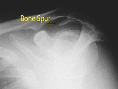 May show bone spur Images Images MRI (Magnetic Resonance