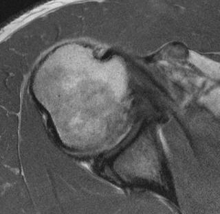 MR Arthrography MRA vs Conventional MR imaging* Labrum Rotator cuff MRA vs Conventional MR imaging and CT