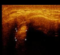 ECHOGENIC fibrocartilage seen within joint space.