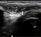 The capsule overlies the labrum Tears will present as areas of anechoic,