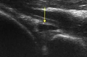 Spino-Glenoid Cyst or Para-Labral Cyst?