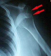 GH Dislocation Traumatic First Time Vs Recurrent
