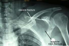 Unusual Fractures